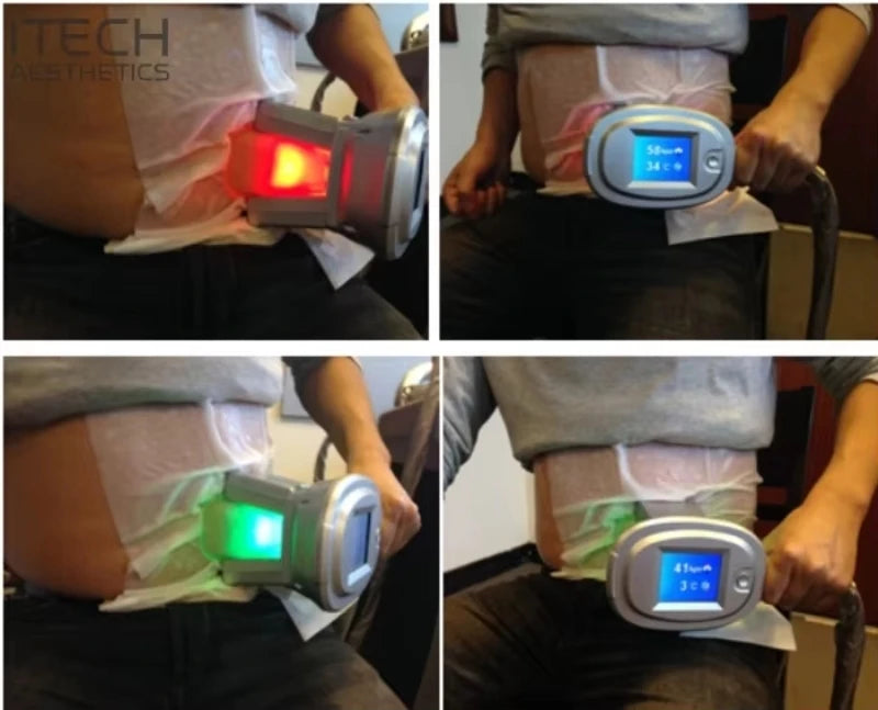 Kryolipolyse Schutzmembran – 60 + 70 g Thick Freezing Mask