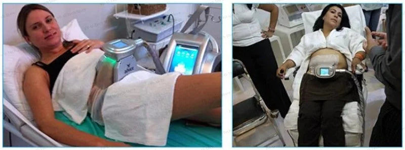 Kryolipolyse Schutzmembran – 60 + 70 g Thick Freezing Mask